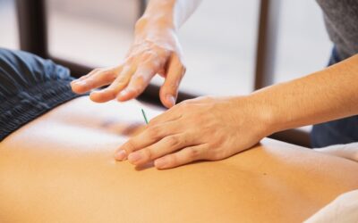 Dry Needling vs. Acupuncture: Which One is Best?