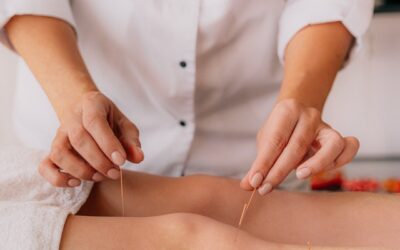 Can Acupuncture for Sciatica Help Relieve Your Pain?